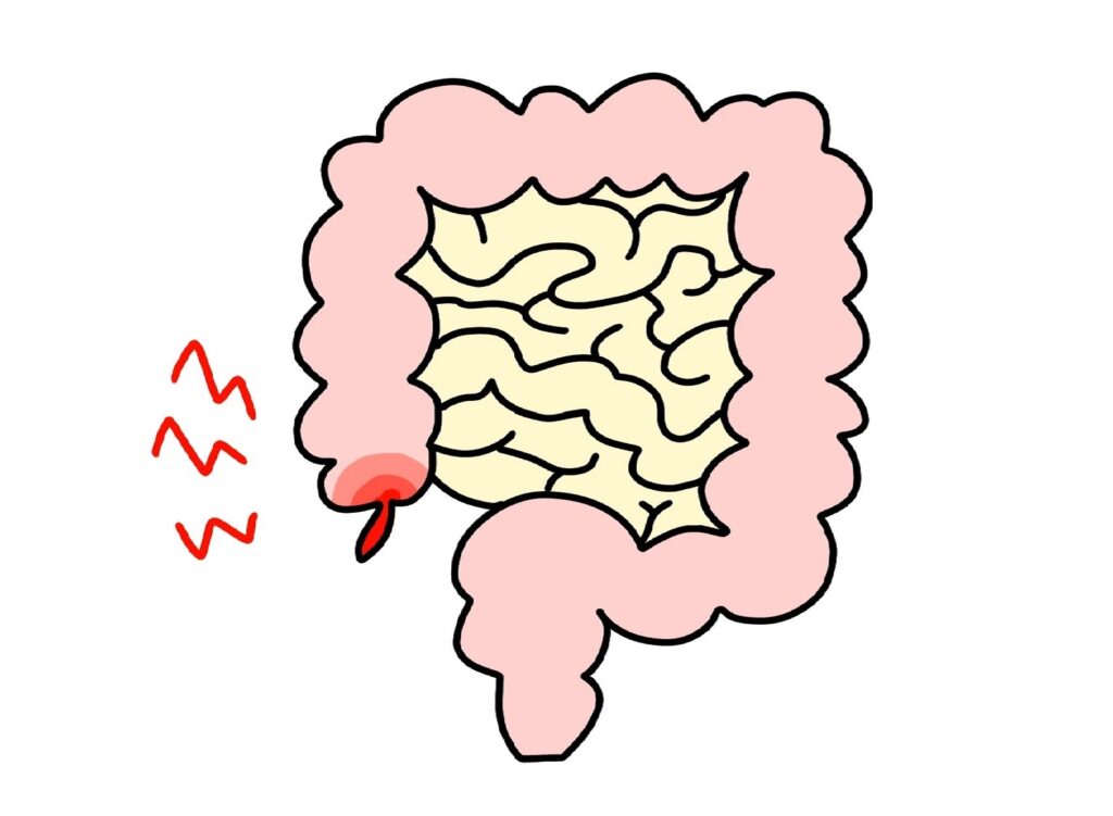 腹痛・発熱・嘔吐の原因　～急性虫垂炎（盲腸）～