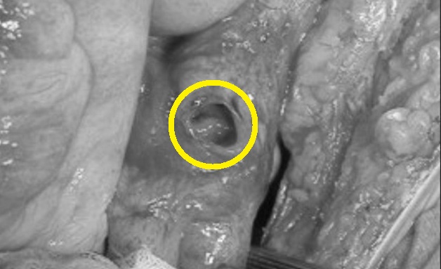 腸に穴があく　～下部消化管穿孔～