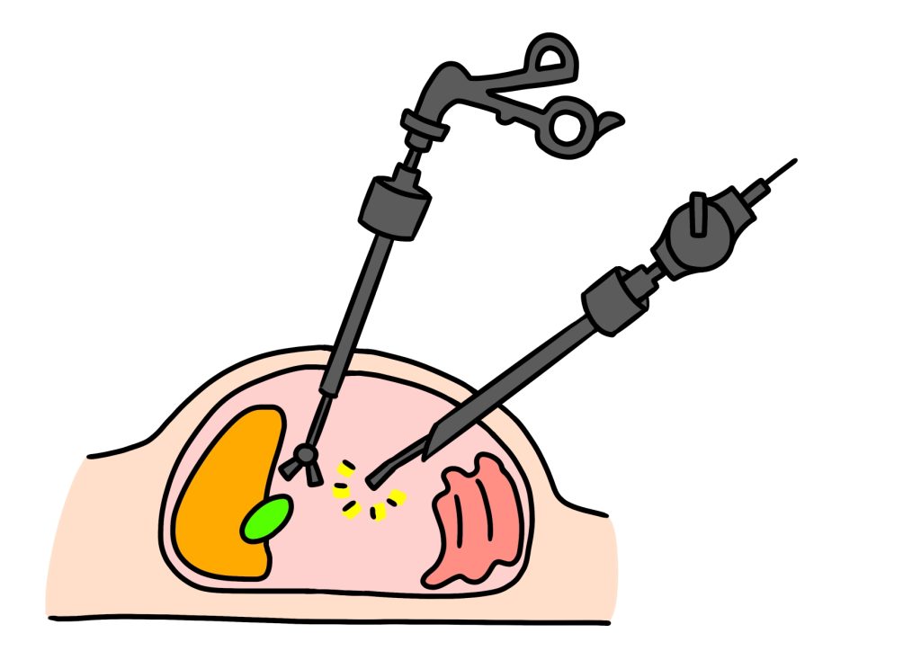 腹腔鏡手術　よくある質問にお答え！